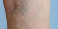 symptoms of varicose veins