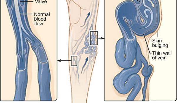 varicose vein forms in a leg